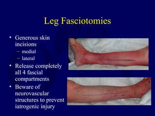 Leg Fasciotomies
• Generous skin
incisions
– medial
– lateral
• Release completely
all 4 fascial
compartments
• Beware of
neurovascular
structures to prevent
iatrogenic injury
 
