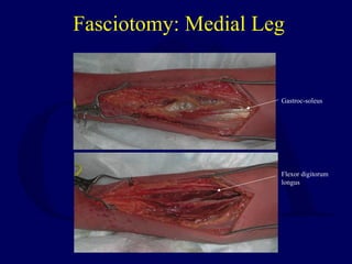 Fasciotomy: Medial Leg
Flexor digitorum
longus
Gastroc-soleus
 