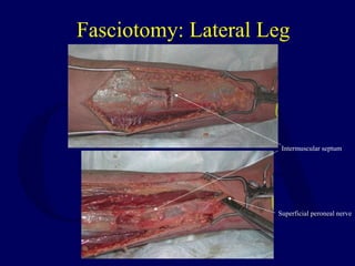 Fasciotomy: Lateral Leg
Superficial peroneal nerve
Intermuscular septum
 