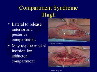 Compartment Syndrome
Thigh
• Lateral to release
anterior and
posterior
compartments
• May require medial
incision for
adductor
compartment
Lateral septum
Vastus lateralis
 