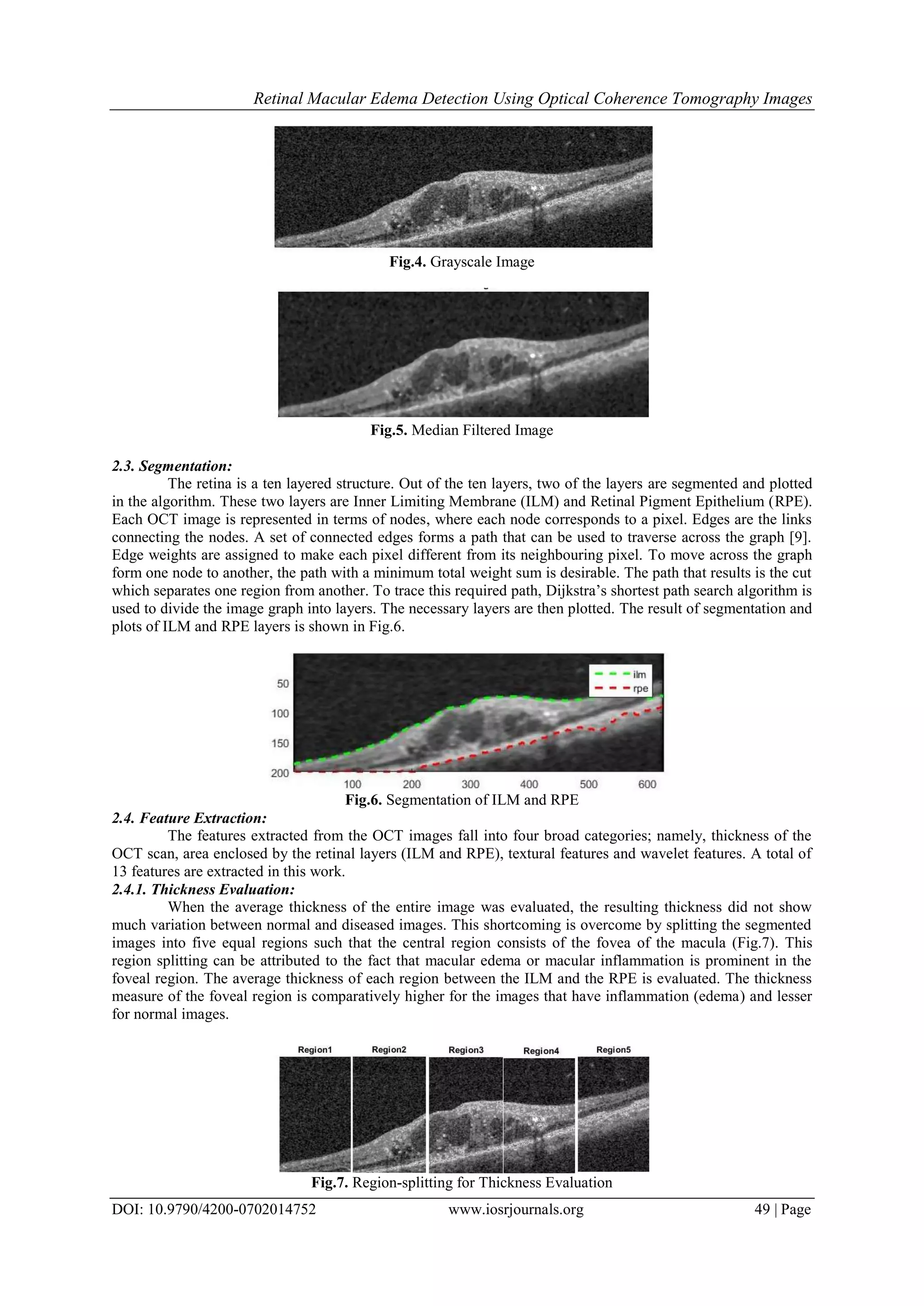 Retinal Macular Edema Detection Using Optical Coherence Tomography Images
DOI: 10.9790/4200-0702014752 www.iosrjournals.org 49 | Page
Fig.4. Grayscale Image
Fig.5. Median Filtered Image
2.3. Segmentation:
The retina is a ten layered structure. Out of the ten layers, two of the layers are segmented and plotted
in the algorithm. These two layers are Inner Limiting Membrane (ILM) and Retinal Pigment Epithelium (RPE).
Each OCT image is represented in terms of nodes, where each node corresponds to a pixel. Edges are the links
connecting the nodes. A set of connected edges forms a path that can be used to traverse across the graph [9].
Edge weights are assigned to make each pixel different from its neighbouring pixel. To move across the graph
form one node to another, the path with a minimum total weight sum is desirable. The path that results is the cut
which separates one region from another. To trace this required path, Dijkstra’s shortest path search algorithm is
used to divide the image graph into layers. The necessary layers are then plotted. The result of segmentation and
plots of ILM and RPE layers is shown in Fig.6.
Fig.6. Segmentation of ILM and RPE
2.4. Feature Extraction:
The features extracted from the OCT images fall into four broad categories; namely, thickness of the
OCT scan, area enclosed by the retinal layers (ILM and RPE), textural features and wavelet features. A total of
13 features are extracted in this work.
2.4.1. Thickness Evaluation:
When the average thickness of the entire image was evaluated, the resulting thickness did not show
much variation between normal and diseased images. This shortcoming is overcome by splitting the segmented
images into five equal regions such that the central region consists of the fovea of the macula (Fig.7). This
region splitting can be attributed to the fact that macular edema or macular inflammation is prominent in the
foveal region. The average thickness of each region between the ILM and the RPE is evaluated. The thickness
measure of the foveal region is comparatively higher for the images that have inflammation (edema) and lesser
for normal images.
Fig.7. Region-splitting for Thickness Evaluation
 