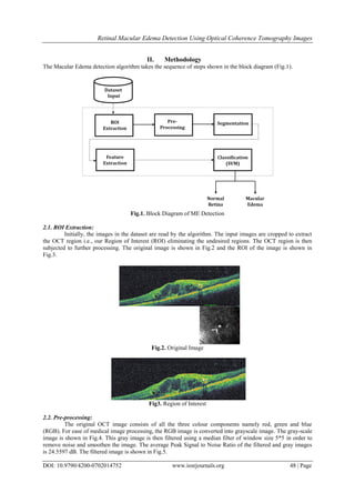 Retinal Macular Edema Detection Using Optical Coherence Tomography Images
DOI: 10.9790/4200-0702014752 www.iosrjournals.org 48 | Page
II. Methodology
The Macular Edema detection algorithm takes the sequence of steps shown in the block diagram (Fig.1).
Fig.1. Block Diagram of ME Detection
2.1. ROI Extraction:
Initially, the images in the dataset are read by the algorithm. The input images are cropped to extract
the OCT region i.e., our Region of Interest (ROI) eliminating the undesired regions. The OCT region is then
subjected to further processing. The original image is shown in Fig.2 and the ROI of the image is shown in
Fig.3.
Fig.2. Original Image
Fig3. Region of Interest
2.2. Pre-processing:
The original OCT image consists of all the three colour components namely red, green and blue
(RGB). For ease of medical image processing, the RGB image is converted into grayscale image. The gray-scale
image is shown in Fig.4. This gray image is then filtered using a median filter of window size 5*5 in order to
remove noise and smoothen the image. The average Peak Signal to Noise Ratio of the filtered and gray images
is 24.5597 dB. The filtered image is shown in Fig.5.
 