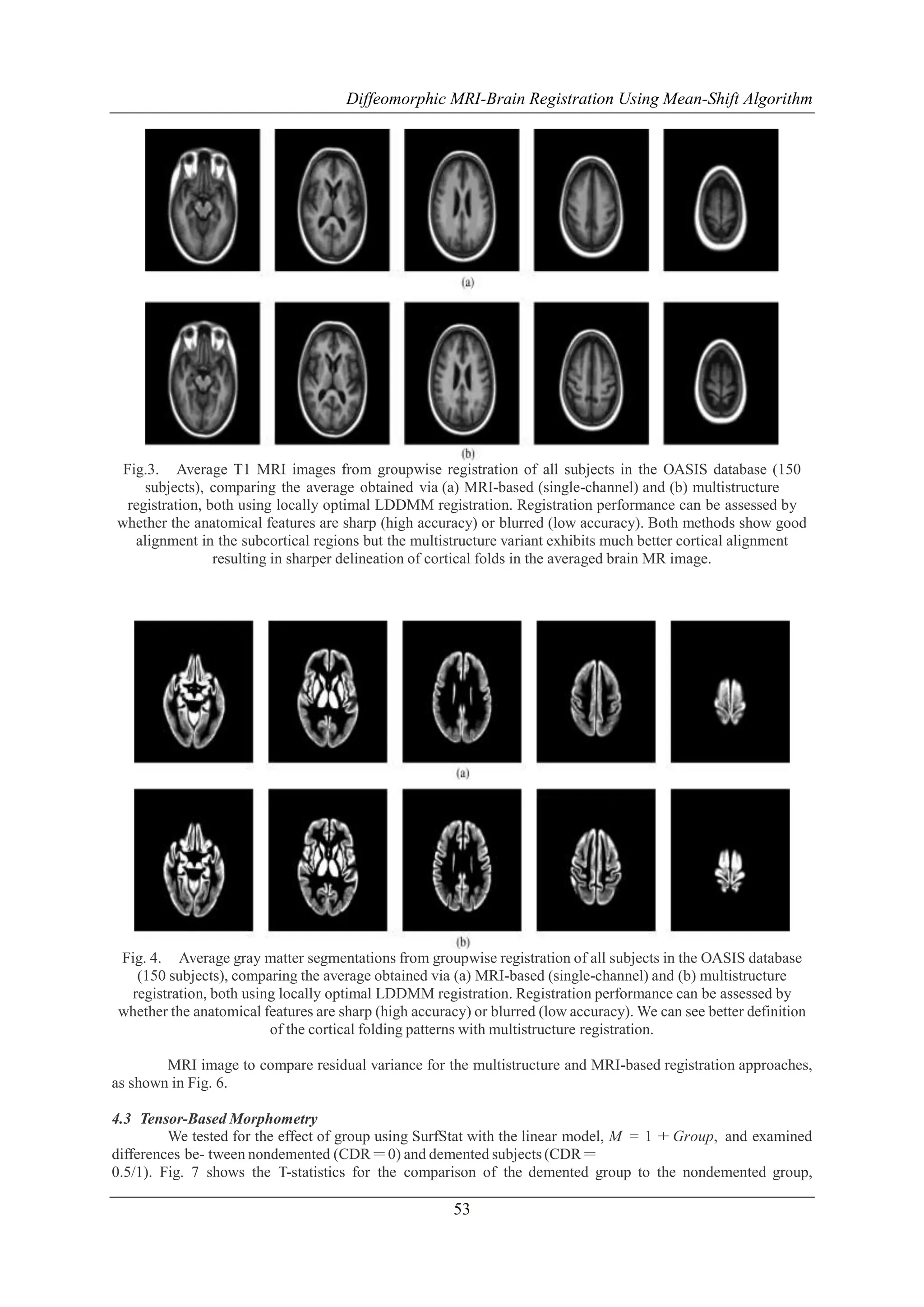 Diffeomorphic MRI-Brain Registration Using Mean-Shift Algorithm

Fig.3. Average T1 MRI images from groupwise registration of all subjects in the OASIS database (150
subjects), comparing the average obtained via (a) MRI-based (single-channel) and (b) multistructure
registration, both using locally optimal LDDMM registration. Registration performance can be assessed by
whether the anatomical features are sharp (high accuracy) or blurred (low accuracy). Both methods show good
alignment in the subcortical regions but the multistructure variant exhibits much better cortical alignment
resulting in sharper delineation of cortical folds in the averaged brain MR image.

Fig. 4. Average gray matter segmentations from groupwise registration of all subjects in the OASIS database
(150 subjects), comparing the average obtained via (a) MRI-based (single-channel) and (b) multistructure
registration, both using locally optimal LDDMM registration. Registration performance can be assessed by
whether the anatomical features are sharp (high accuracy) or blurred (low accuracy). We can see better definition
of the cortical folding patterns with multistructure registration.
MRI image to compare residual variance for the multistructure and MRI-based registration approaches,
as shown in Fig. 6.
4.3 Tensor-Based Morphometry
We tested for the effect of group using SurfStat with the linear model, M = 1 + Group, and examined
differences be- tween nondemented (CDR = 0) and demented subjects (CDR =
0.5/1). Fig. 7 shows the T-statistics for the comparison of the demented group to the nondemented group,

53

 