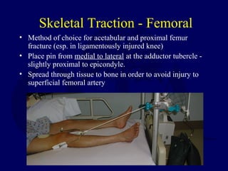 Skeletal Traction - Femoral
• Method of choice for acetabular and proximal femur
fracture (esp. in ligamentously injured knee)
• Place pin from medial to lateral at the adductor tubercle -
slightly proximal to epicondyle.
• Spread through tissue to bone in order to avoid injury to
superficial femoral artery
 