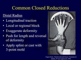 Common Closed Reductions
Distal Radius
• Longitudinal traction
• Local or regional block
• Exaggerate deformity
• Push for length and reversal
of deformity
• Apply splint or cast with
3-point mold
Figure from: Rockwood and Green: Fractures in
Adults, 4th ed, Lippincott, 1996.
 