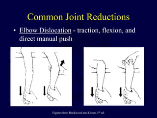 Common Joint Reductions
• Elbow Dislocation - traction, flexion, and
direct manual push
Figures from Rockwood and Green, 5th ed.
 