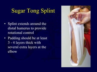 Sugar Tong Splint
• Splint extends around the
distal humerus to provide
rotational control
• Padding should be at least
3 - 4 layers thick with
several extra layers at the
elbow
 
