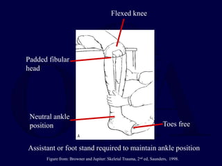 Padded fibular
head
Flexed knee
Neutral ankle
position Toes free
Assistant or foot stand required to maintain ankle position
Figure from: Browner and Jupiter: Skeletal Trauma, 2nd ed, Saunders, 1998.
 