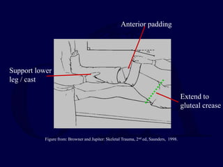Anterior padding
Support lower
leg / cast
Extend to
gluteal crease
Figure from: Browner and Jupiter: Skeletal Trauma, 2nd ed, Saunders, 1998.
 
