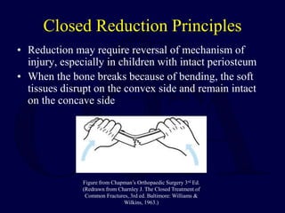 Closed Reduction Principles
• Reduction may require reversal of mechanism of
injury, especially in children with intact periosteum
• When the bone breaks because of bending, the soft
tissues disrupt on the convex side and remain intact
on the concave side
Figure from Chapman’s Orthopaedic Surgery 3rd Ed.
(Redrawn from Charnley J. The Closed Treatment of
Common Fractures, 3rd ed. Baltimore: Williams &
Wilkins, 1963.)
 