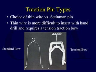 Traction Pin Types
• Choice of thin wire vs. Steinman pin
• Thin wire is more difficult to insert with hand
drill and requires a tension traction bow
Tension Bow
Standard Bow
 