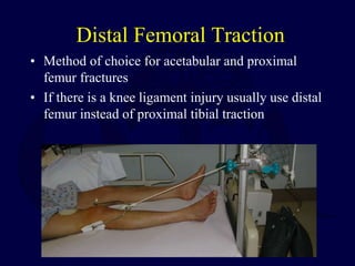 Distal Femoral Traction
• Method of choice for acetabular and proximal
femur fractures
• If there is a knee ligament injury usually use distal
femur instead of proximal tibial traction
 