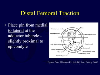 Distal Femoral Traction
• Place pin from medial
to lateral at the
adductor tubercle -
slightly proximal to
epicondyle
Figures from Althausen PL, Hak DJ. Am J Orthop. 2002.
 