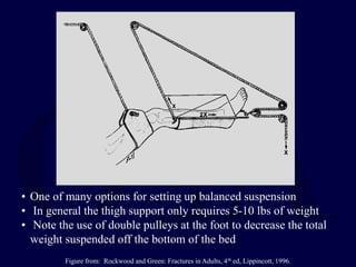 • One of many options for setting up balanced suspension
• In general the thigh support only requires 5-10 lbs of weight
• Note the use of double pulleys at the foot to decrease the total
weight suspended off the bottom of the bed
Figure from: Rockwood and Green: Fractures in Adults, 4th ed, Lippincott, 1996.
 