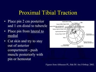 Proximal Tibial Traction
• Place pin 2 cm posterior
and 1 cm distal to tubercle
• Place pin from lateral to
medial
• Cut skin and try to stay
out of anterior
compartment - push
muscle posteriorly with
pin or hemostat
Figures from Althausen PL, Hak DJ. Am J Orthop. 2002.
 