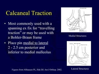 Calcaneal Traction
• Most commonly used with a
spanning ex fix for “travelling
traction” or may be used with
a Bohler-Braun frame
• Place pin medial to lateral
2 - 2.5 cm posterior and
inferior to medial malleolus
Medial Structures
Lateral Structures
Figures from Althausen PL, Hak DJ. Am J Orthop. 2002.
 