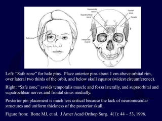 Left: “Safe zone” for halo pins. Place anterior pins about 1 cm above orbital rim,
over lateral two thirds of the orbit, and below skull equator (widest circumference).
Right: “Safe zone” avoids temporalis muscle and fossa laterally, and supraorbital and
supatrochlear nerves and frontal sinus medially.
Posterior pin placement is much less critical because the lack of neuromuscular
structures and uniform thickness of the posterior skull.
Figure from: Botte MJ, et al. J Amer Acad Orthop Surg. 4(1): 44 – 53, 1996.
 