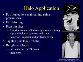 Halo Application
• Position patient maintaining spine
precautions
• Fit Halo ring
• Prep pin sites
– Anterior - outer half above eyebrow avoiding
supraorbital artery, nerve, and sinus
– Posterior - superior and posterior to ear
• Tighten pins to 6 - 8ft-lbs.
• Retighten if loose
– Pins only once at 24 hours
– Frame prn
Figure from: Rockwood and Green:
Fractures in Adults, 4th ed, Lippincott, 1996.
 