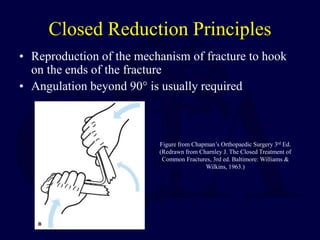 Closed Reduction Principles
• Reproduction of the mechanism of fracture to hook
on the ends of the fracture
• Angulation beyond 90° is usually required
Figure from Chapman’s Orthopaedic Surgery 3rd Ed.
(Redrawn from Charnley J. The Closed Treatment of
Common Fractures, 3rd ed. Baltimore: Williams &
Wilkins, 1963.)
 