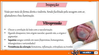 Jens Martensson 4
Inspeção
Visão por meio de forma direta e indireta. Sendo facilitado pela secagem com ar,
afastadores e boa iluminação.
Vitropressão
• Checar a correlaçãoda lesão com a vascularização.
• Quando desaparece, tem origem vascular, quando não, a origem é
pigmentar.
• Isquemia:sangue contido em vasos (hiperemias, hemangiomas,
teleangiectsias e varicosidades)
• Persistênciasda coloração:hematoma, inflamação, eritroplasia ou trombo
 