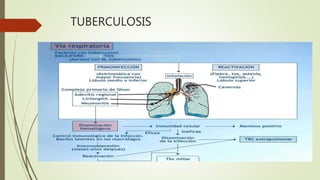 TUBERCULOSIS
 