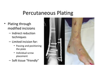 Percutaneous Incision principles of internal fixation | PPT