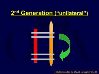 2nd Generation (“unilateral”)
Slide provided by David Lowenberg M.D
 