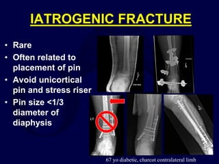 IATROGENIC FRACTURE
• Rare
• Often related to
placement of pin
• Avoid unicortical
pin and stress riser
• Pin size <1/3
diameter of
diaphysis
67 yo diabetic, charcot contralateral limb
 