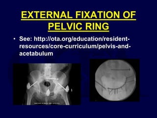 EXTERNAL FIXATION OF
PELVIC RING
• See: http://ota.org/education/resident-
resources/core-curriculum/pelvis-and-
acetabulum
 