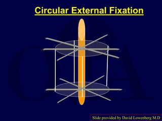 Circular External Fixation
Slide provided by David Lowenberg M.D
 