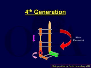 4th Generation
Shear
Component
Slide provided by David Lowenberg M.D
 