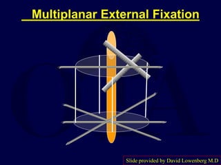 Multiplanar External Fixation
Slide provided by David Lowenberg M.D
 