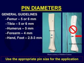 PIN DIAMETERS
GENERAL GUIDELINES
–Femur – 5 or 6 mm
–Tibia – 5 or 6 mm
–Humerus – 5 mm
–Forearm – 4 mm
–Hand, Foot – 2.5-3 mm
Photos courtesy of Matthew Camuso
Use the appropriate pin size for the application
Avoid unicortical pin
 
