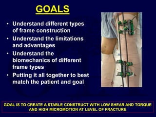 GOALS
• Understand different types
of frame construction
• Understand the limitations
and advantages
• Understand the
biomechanics of different
frame types
• Putting it all together to best
match the patient and goal
GOAL IS TO CREATE A STABLE CONSTRUCT WITH LOW SHEAR AND TORQUE
AND HIGH MICROMOTION AT LEVEL OF FRACTURE
 