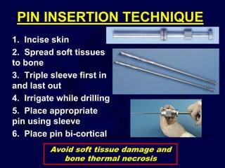 PIN INSERTION TECHNIQUE
1. Incise skin
2. Spread soft tissues
to bone
3. Triple sleeve first in
and last out
4. Irrigate while drilling
5. Place appropriate
pin using sleeve
6. Place pin bi-cortical
Avoid soft tissue damage and
bone thermal necrosis
 