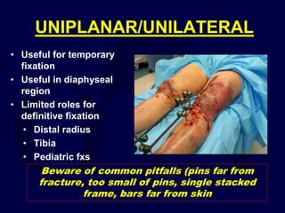 UNIPLANAR/UNILATERAL
• Useful for temporary
fixation
• Useful in diaphyseal
region
• Limited roles for
definitive fixation
• Distal radius
• Tibia
• Pediatric fxs
Beware of common pitfalls (pins far from
fracture, too small of pins, single stacked
frame, bars far from skin
 
