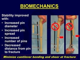 BIOMECHANICS
Stability improved
with:
• Increased pin
diameter
• Increased pin
spread
• Increased
number of pins
• Decreased
distance from pin
to fracture
Minimize cantilever bending and sheer at fracture
 