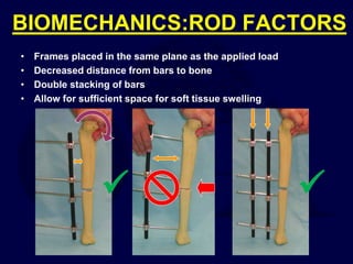 BIOMECHANICS:ROD FACTORS
• Frames placed in the same plane as the applied load
• Decreased distance from bars to bone
• Double stacking of bars
• Allow for sufficient space for soft tissue swelling


 