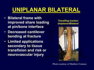 UNIPLANAR BILATERAL
• Bilateral frame with
improved share loading
at pin/bone interface
• Decreased cantilever
bending at fracture
• Limited applications
secondary to tissue
transfixion and risk or
neurovascular injury
Travelling traction
Uniplanar/Bilateral
Photo courtesy of Matthew Camuso
 