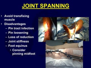 JOINT SPANNING
• Avoid transfixing
muscle
• Disadvantages
– Pin tract infection
– Pin loosening
– Loss of reduction
– Joint stiffness
– Foot equinus
• Consider
pinning midfoot
 