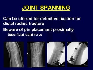 JOINT SPANNING
Can be utilized for definitive fixation for
distal radius fracture
Beware of pin placement proximally
Superficial radial nerve
 
