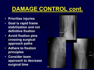 DAMAGE CONTROL cont.
• Prioritize injuries
• Goal is rapid frame
stabilization and not
definitive fixation
• Avoid fixation pins
crossing surgical
approach paths
• Adhere to fixation
principles
• Consider team
approach to decrease
surgical time
 