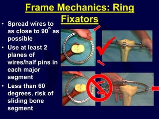 Frame Mechanics: Ring
Fixators
• Spread wires to
as close to 90
o
as
possible
• Use at least 2
planes of
wires/half pins in
each major
segment
• Less than 60
degrees, risk of
sliding bone
segment

 