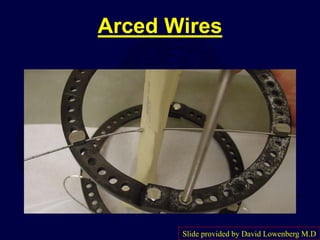 Arced Wires
Slide provided by David Lowenberg M.D
 