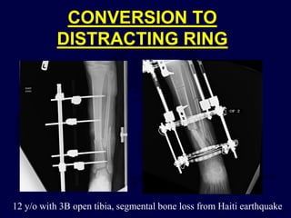 CONVERSION TO
DISTRACTING RING
12 y/o with 3B open tibia, segmental bone loss from Haiti earthquake
 