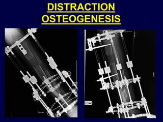 DISTRACTION
OSTEOGENESIS
 