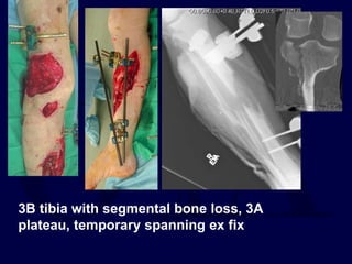 3B tibia with segmental bone loss, 3A
plateau, temporary spanning ex fix
 