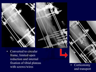 • Converted to circular
frame, limited open
reduction and internal
fixation of tibial plateau
with screws/wires
• Corticotomy
and transport
 