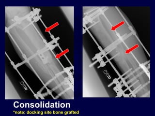 Consolidation
*note: docking site bone grafted
 