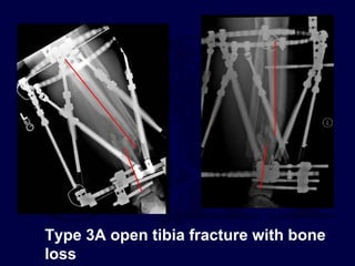 Type 3A open tibia fracture with bone
loss
 